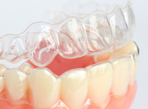 Invisible Braces With An Affordable Price Tag