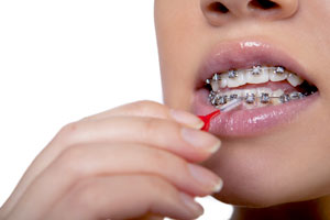 Clean You Braces Regularly More So Than Teeth Cleaning
