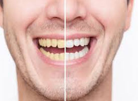 Keep Your Teeth Whiter And Avoid Staining