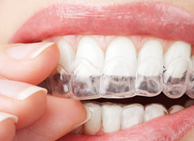 Professional Invisible Braces For A Great Smile