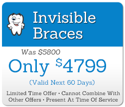 Great Offer For Invisible Braces