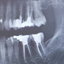X-ray Of Teeth With Root Canal And Cavity Treatment